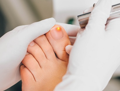 Laser Nail Fungus Treatment