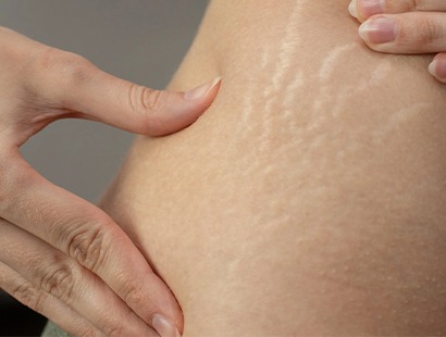 Stretch Marks
