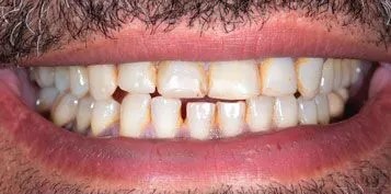 Veneers-Before-and-after-1