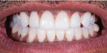 Veneers-Before-and-after-2