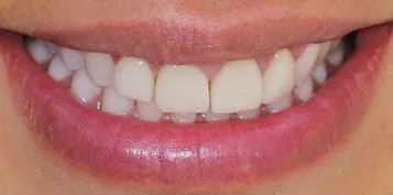 Veneers-Before-and-after-3