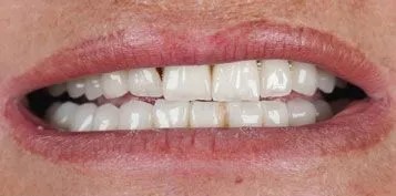 Veneers-Before-and-after-4