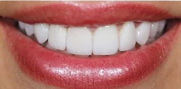 Veneers-Before-and-after-4