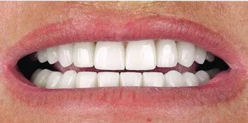 Veneers-Before-and-after-5
